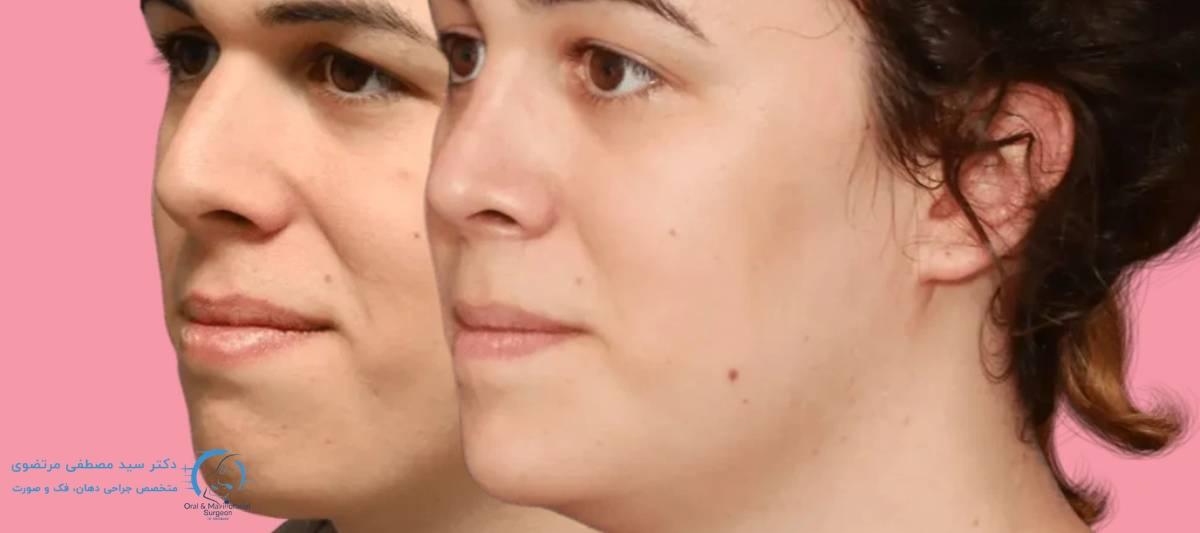 با این تفاسیر، آیا تغییرات چهره پس از جراحی فک به_راحتی قابل مشاهده است؟