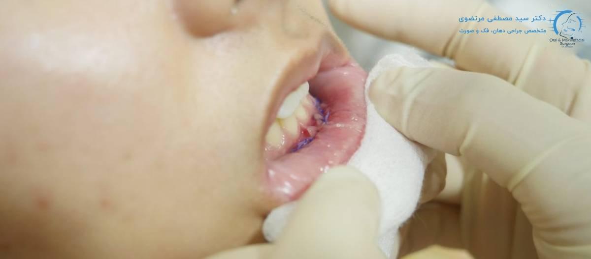 مرحله بهبودی اولیه