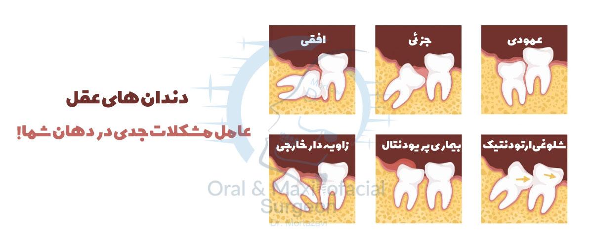 انواع-رویش-دندان-های-عقل---کلینیک-دکتر-مرتضوی