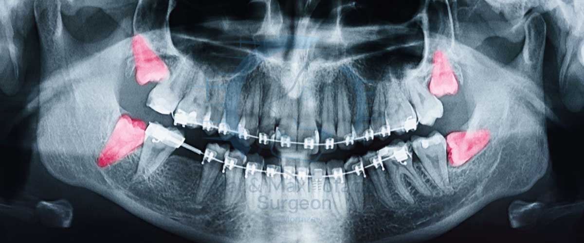تصویر-رادیوگرافی-از-دندان-عقل-نهفته-که-به-دندان‌های-دیگر-فشار-وارد-می‌کند-و-باعث-آسیب-به-ریشه-آن‌ها-شده-است--کلینیک-دکتر-مرتضوی
