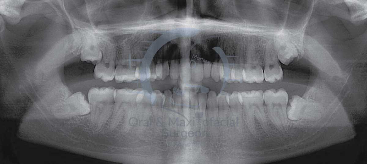 تصویر-رادیوگرافی-دندان-های-عقل-نهفته-بیماری-28-ساله-کلینیک-دکتر-مرتضوی
