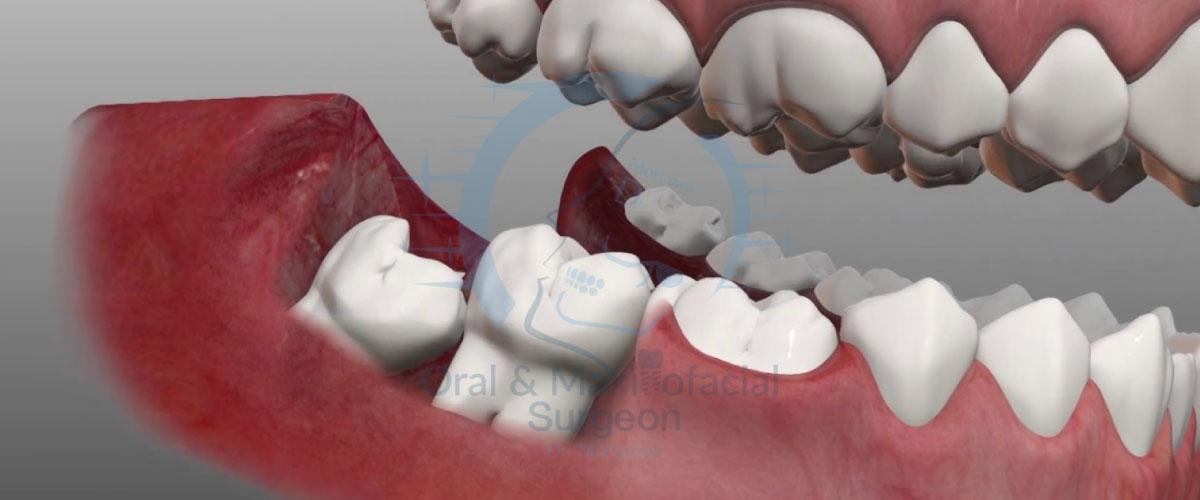 جراحی-دندان-عقل-نهفته-درکلینیک-دکتر-مرتضوی