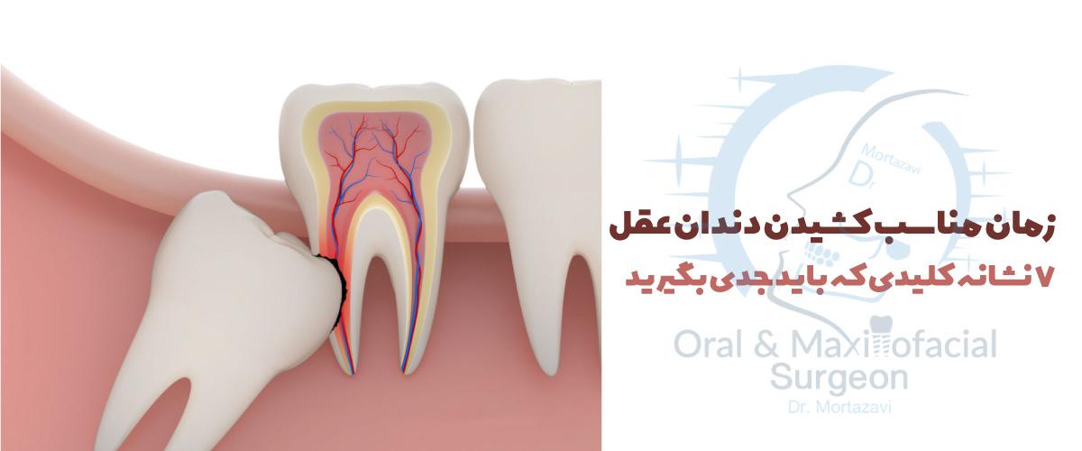 زمان-مناسب-کشیدن-دندان-عقل-کلینیک-دکتر-مرتضوی