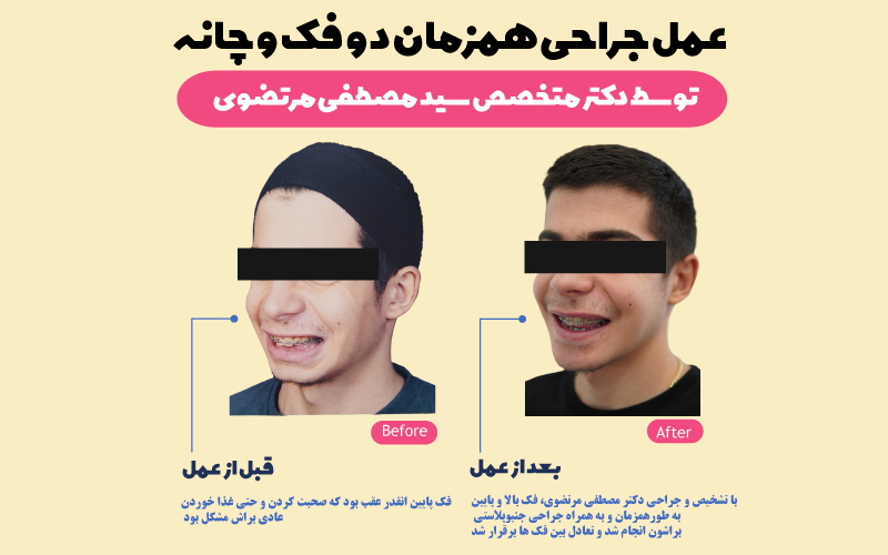 نمونه-ای-از-جراحی-همزمان-دوفک-و-چانه-توسط-دکتر-سید-مصطفی-مرتضوی
