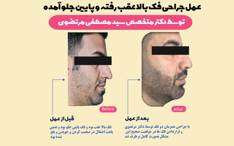 نمونه-جراحی-فک-بالا-عقب-رفته-و-فک-پایین-جلو-آمده-از-دکتر-مرتضوی-جراح-فک-و-صورت