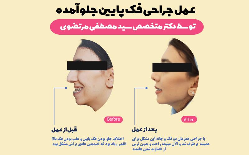 نمونه-جراحی-فک-پایین-جلو-آمده-توسط-دکتر-مرتضوی-بهترین-متخصص-فک-و-صورت-در-تهران-و-کرج