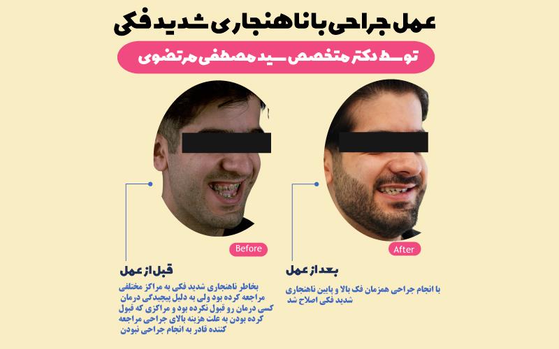 نمونه-عمل-جراحی-فک-با-مشکل-ناهنجاری-شدید-توسط-دکتر-مصطفی-مرتضوی-جراح-فوق-تخصص-فک-و-صورت