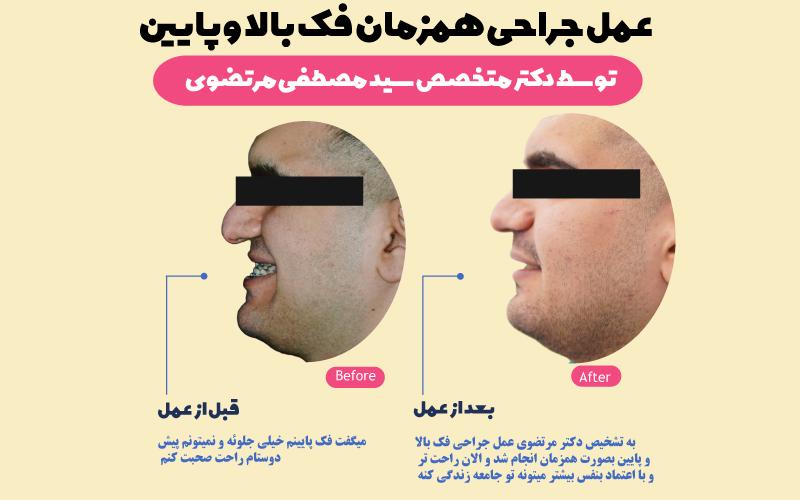 نمونه-عمل-جراحی-فک-بالا-و-پایین-همزمان-توسط-دکتر-مصطفی-مرتضوی