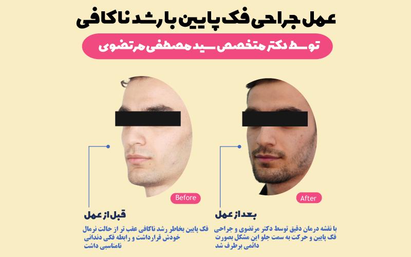 نمونه-عمل-جراحی-فکی-که-که-رشد-کافی-نداشته-توسط-دکتر-مصطفی-مرتضوی